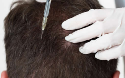 Mesoterapia capilar