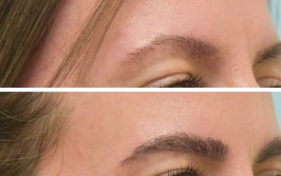 Trasplante de cejas