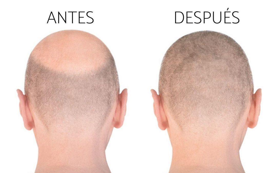 Injertos de Cabello Antes y Después: Transformando tu Cabello y tu Vida
