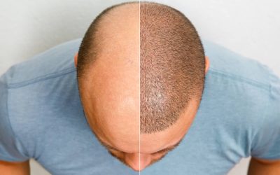 Microinjerto Capilar: Precisión y Naturalidad en la Recuperación Capilar