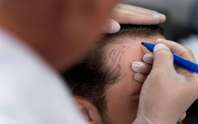 Trasplante capilar en entradas: cómo recuperar el cabello frontal