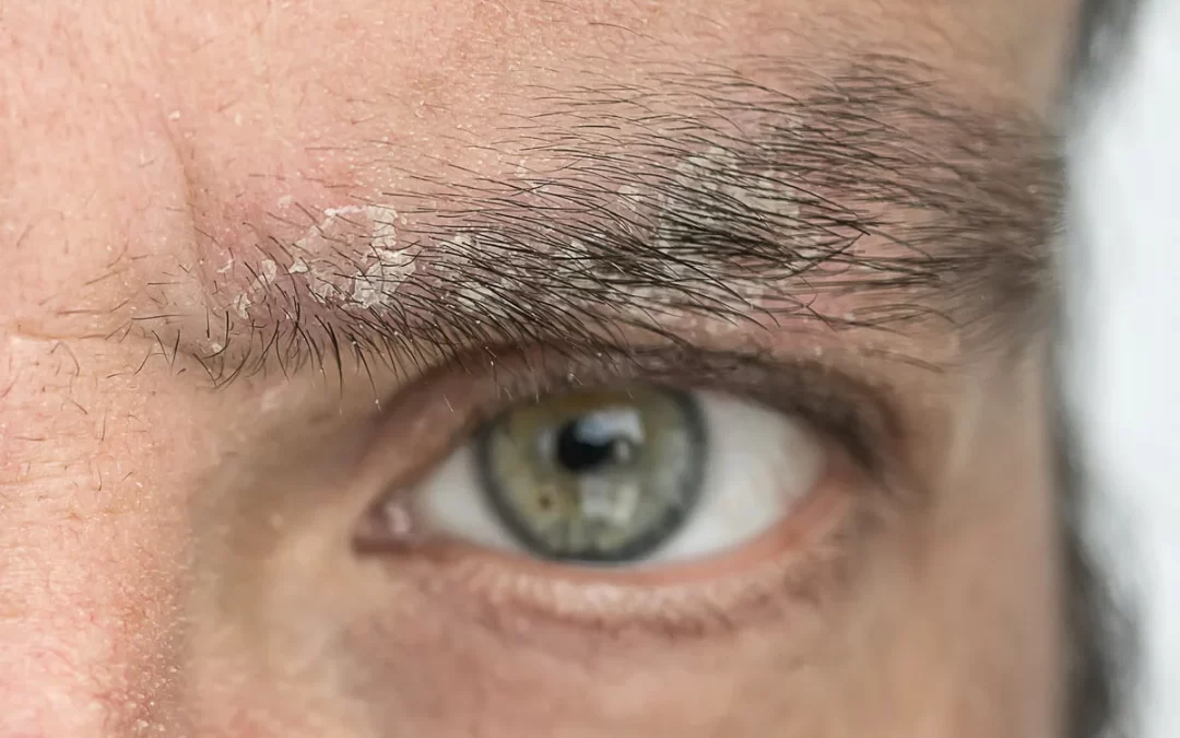 Dermatitis Seborreica: Causas, Síntomas y Tratamientos Eficaces