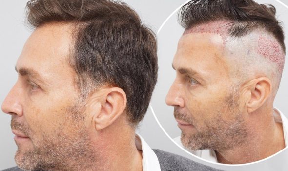Factores que afectan el crecimiento del cabello