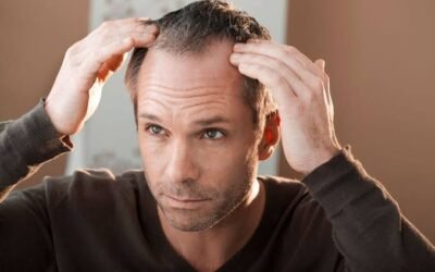 ¿Qué pasa si la alopecia continúa después de un implante capilar?