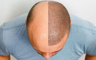 Implante capilar en pacientes con alopecia avanzada: ¿qué resultados se pueden esperar?