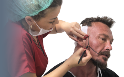 Implante capilar en barba: ¿qué problemas de densidad puede solucionar?