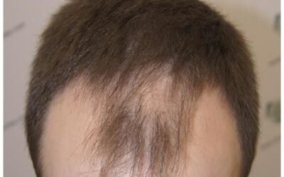 ¿Se puede realizar un implante capilar si tengo el pelo muy fino?